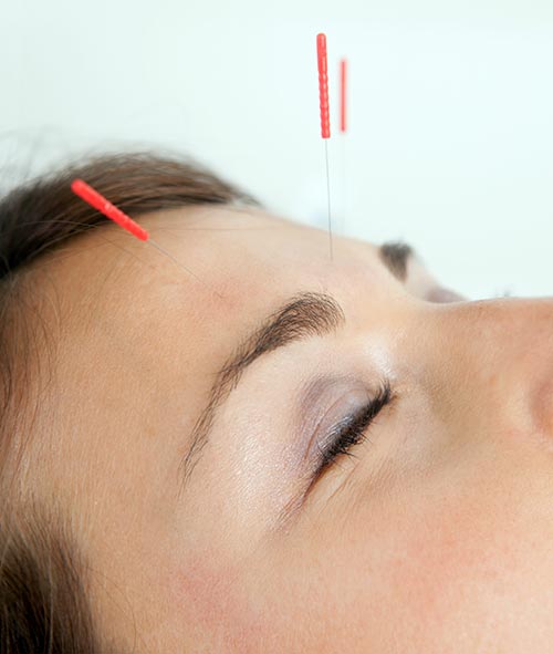 Una mujer con agujas de acupuntura en su frente.
